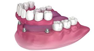 Implant-Supported Options