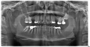 Digital X-Rays