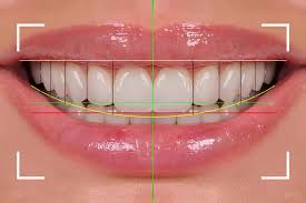 Smile Makeover